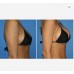 20ml Acido Hialuronico Dermal Filler hydrogel buttock injection