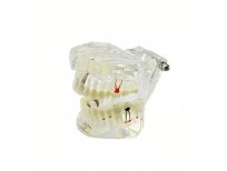 ZJKC Transparent Dental Implant Disease Teeth Model Dentist Standard Pathological Removable Tooth Teaching Tools