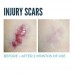 Advanced Silicone Scar Gel for Face, Body, Surgical, Burn, Acne and C Section Scar Treatment, Clinically Proven Shop in Pakistan