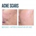 Advanced Silicone Scar Gel for Face, Body, Surgical, Burn, Acne and C Section Scar Treatment, Clinically Proven Shop in Pakistan