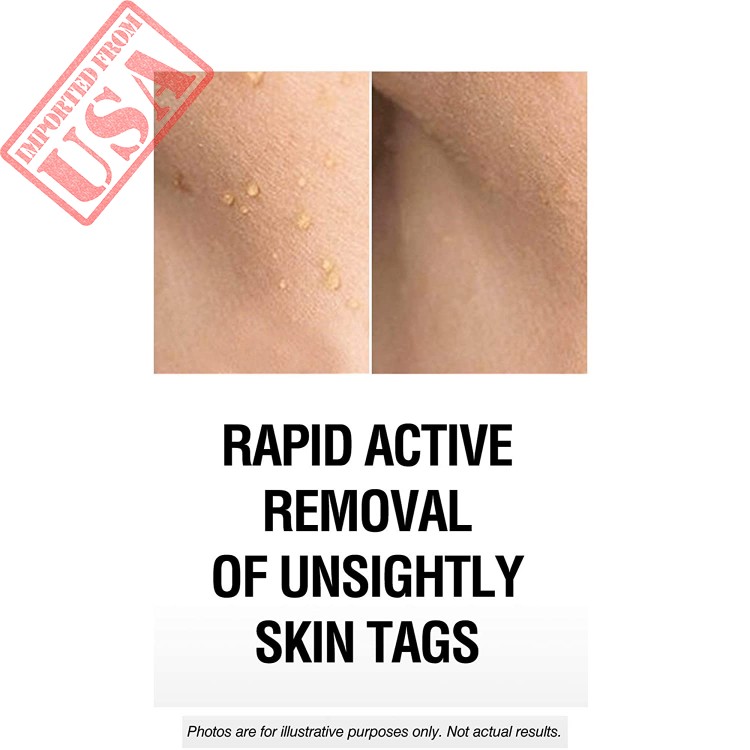 Skinpro Extreme Skin Tag Remover And Mole Corrector Fast