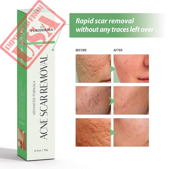 High Quality Acne Scar Removal Cream Treatment for Face imported from USA, for Sale in Pakistan