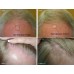 RegrowMD Laser Cap 272 (FDA Cleared), 272 Lasers | Stimulate Hair Growth, Reverse Thinning Buy in Pakistan