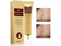 Best Acne Scar Removal Cream - Acne Spots Treatment & Stretch Marks Relief Buy in Pakistan