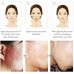 Best Acne Scar Removal Cream - Acne Spots Treatment & Stretch Marks Relief Buy in Pakistan