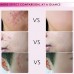 BUY HIGH QUALITY SCAR REMOVAL CREAM SKIN REPAIR SCAR ACNE TREATMENT CREAM SKIN CARE IMPORTED FROM USA