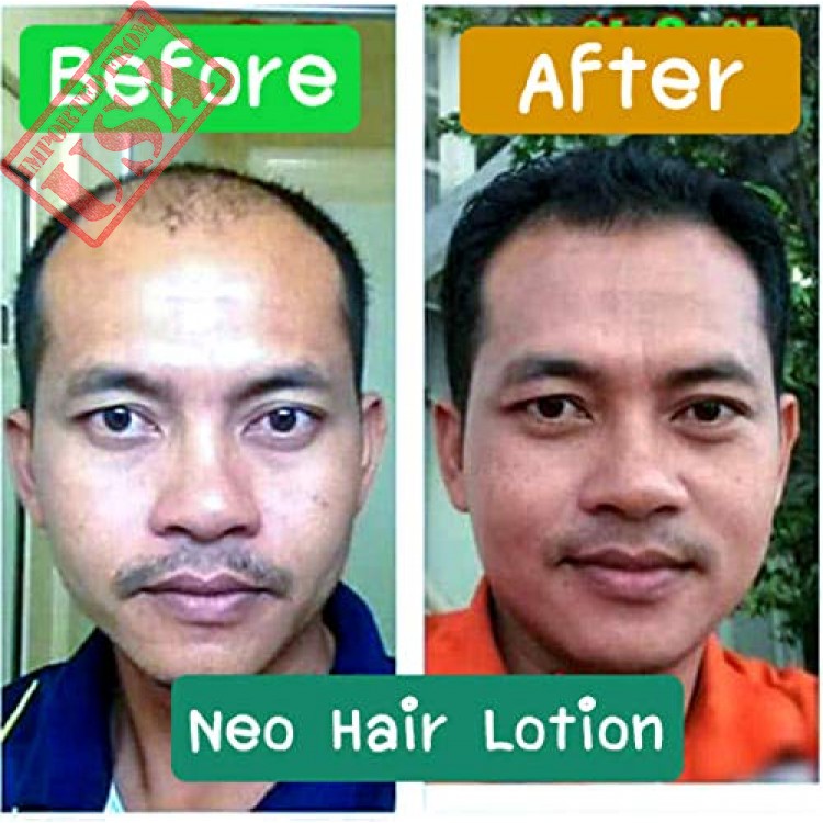 Natural Herbal New Hair Regrowth Lotion - Neo Hair Lotion - Made in Thailand