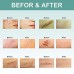 Buy Top Selling Scar Removal Cream | Effective for Ance Scars, Surgery Scars & Stretch Marks