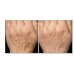 25%TCA Peel Medium Depth, Wrinkles, Age Spots, Crepey Skin (1oz / 30ml)